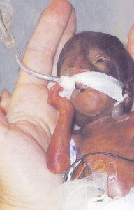 Amillia Taylor – dziecko, które przeżyło, urodzone w 22. tygodniu ciąży